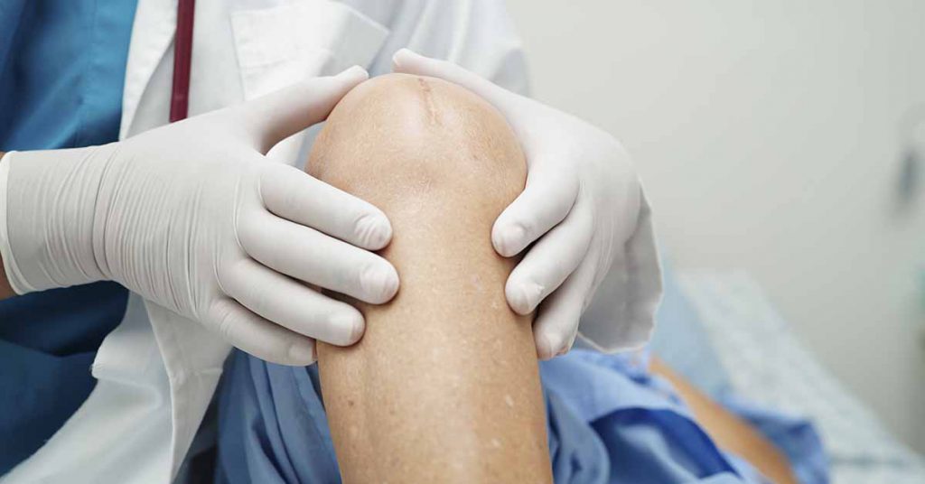 O que é Artrose (Osteoartrite)? Entenda o desgaste e como viver sem dor