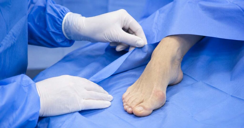Cirurgia de joanete: quando o hálux valgo precisa de correção?